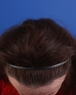 After Hair Transplant&nbsp;Hairline